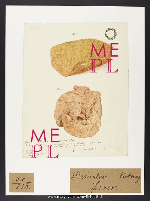 : Granular: Nutmeg Liver : Granular: Nutmeg Liver