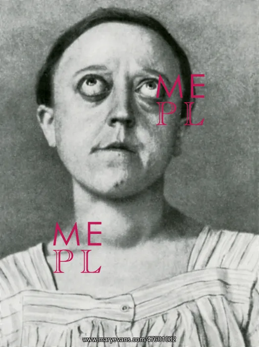 : Graves Disease : Graves Disease