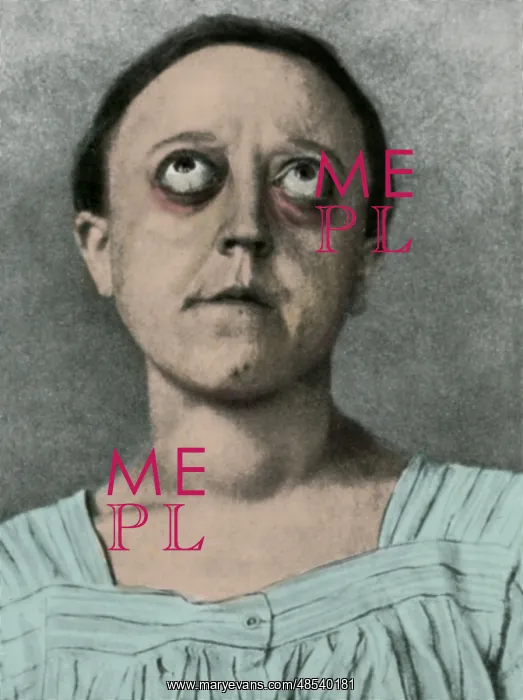  : Graves Disease