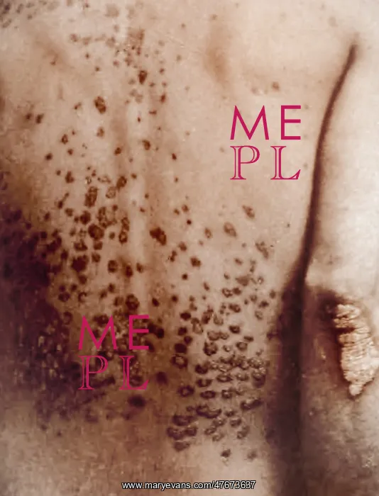 : Guttate Psoriasis, Historical : Guttate Psoriasis, Historical