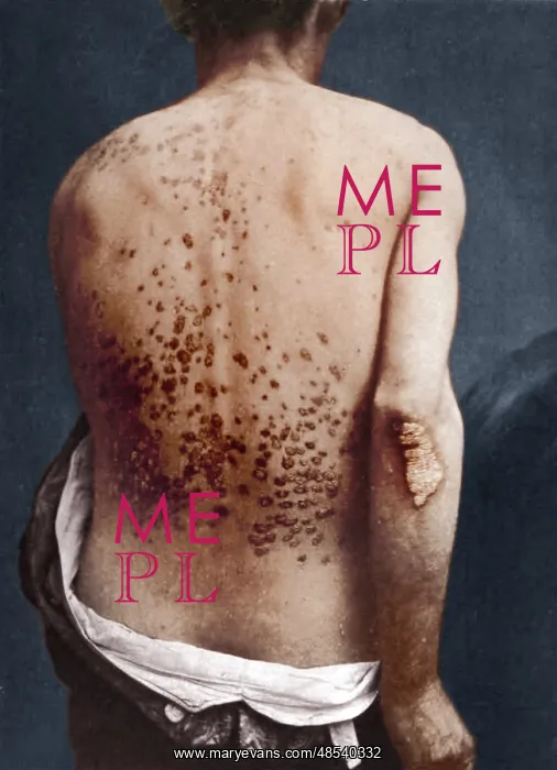: Guttate Psoriasis, Historical : Guttate Psoriasis, Historical