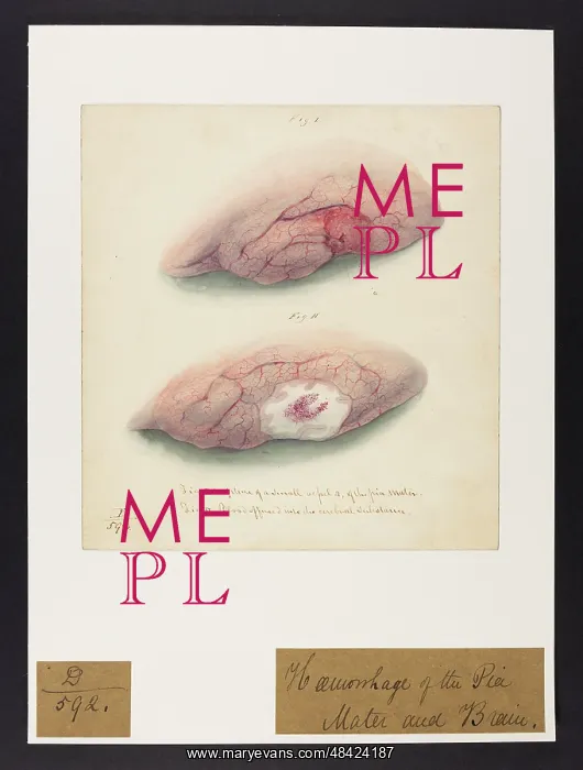 : Haemorrhage of Pia Mater and Brain : Haemorrhage of Pia Mater and Brain