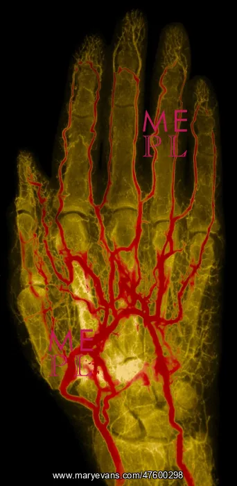 : Hand Arteriogram : Hand Arteriogram