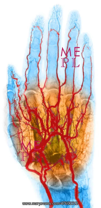 : Hand Arteriogram : Hand Arteriogram