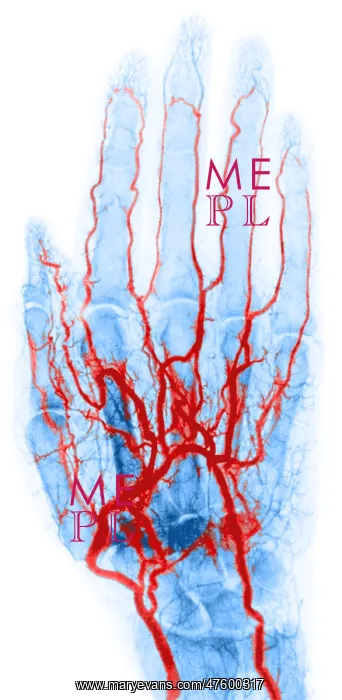 : Hand Arteriogram : Hand Arteriogram