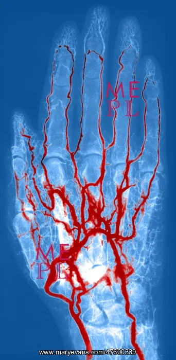 : Hand Arteriogram : Hand Arteriogram
