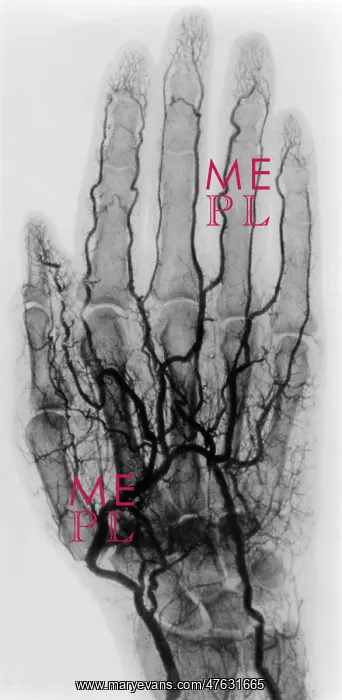  : Hand Arteriogram