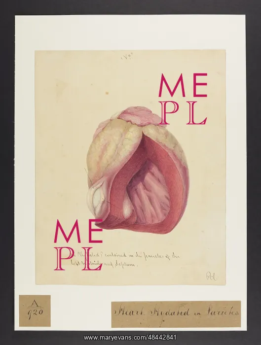  : Heart: Hydatid in Parietes