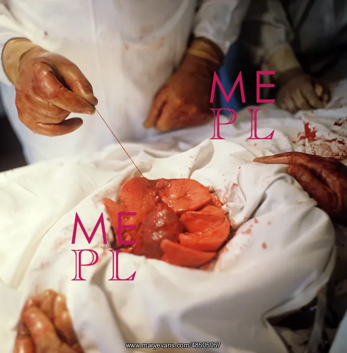 : Heart transplantation, 1973 : Heart transplantation, 1973