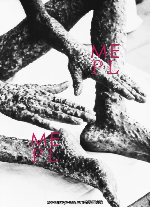 : The heavily pockmarked hands, legs, and ? : The heavily pockmarked hands, legs, and ?