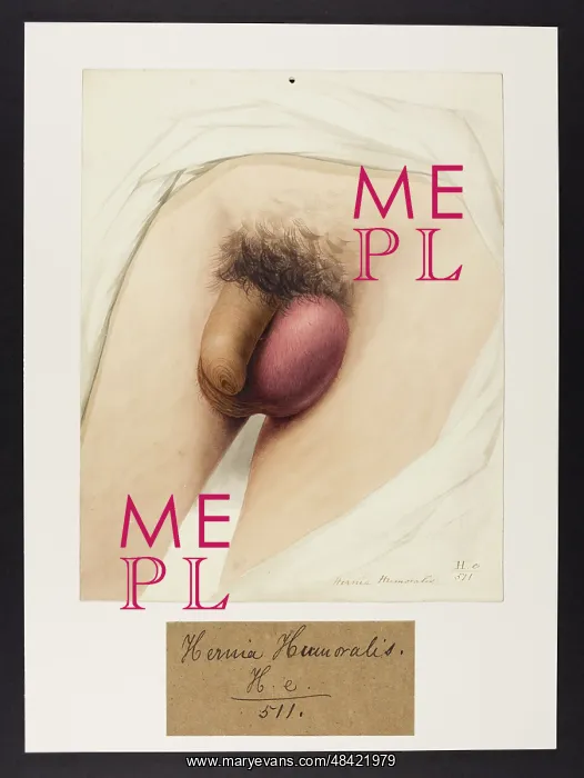 : Hernia Humoralis : Hernia Humoralis