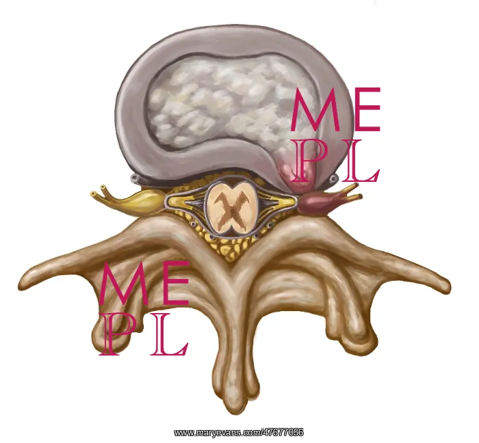 : Herniated Disk, Illustration : Herniated Disk, Illustration