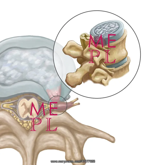 : Herniated Disk, Illustration : Herniated Disk, Illustration