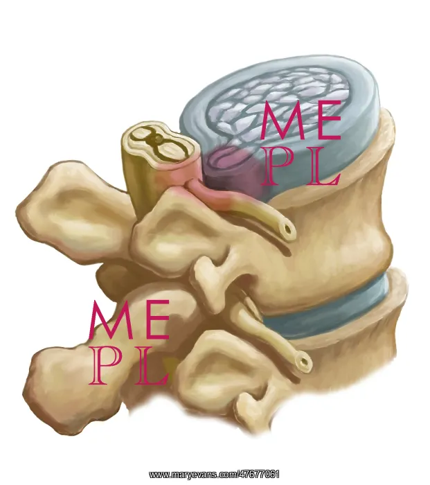  : Herniated Disk, Illustration