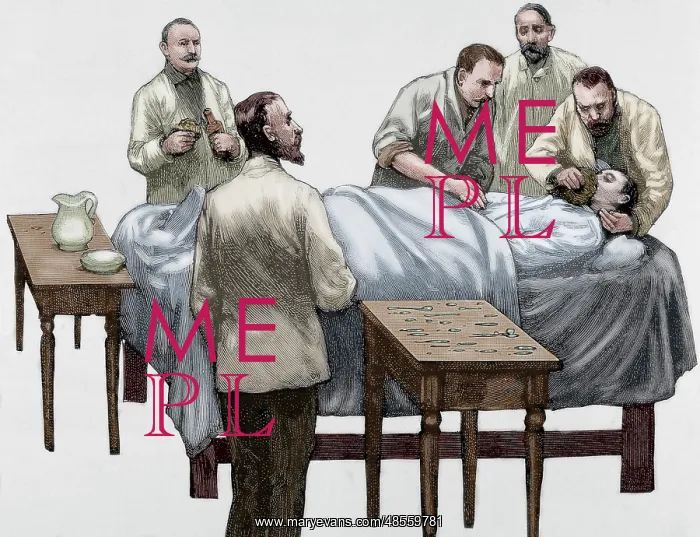 : History of medicine. Chloroform anesthesia. Engraving, 19th : History of medicine. Chloroform anesthesia. Engraving, 19th