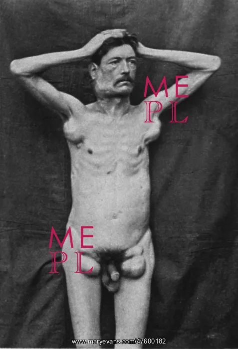 : Hodgkin's Disease, 1892 : Hodgkin's Disease, 1892