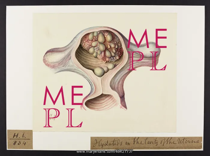 : Hydatids: Cavity of Uterus : Hydatids: Cavity of Uterus