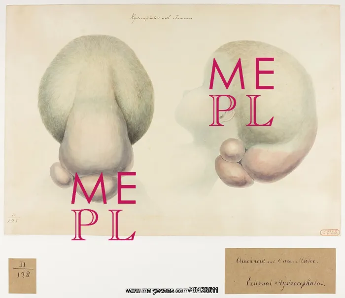 : Hydrocephalus : Hydrocephalus