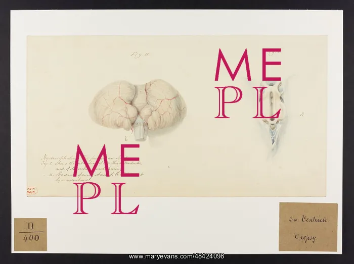  : Hydrocephalus: The Patient an Idiot