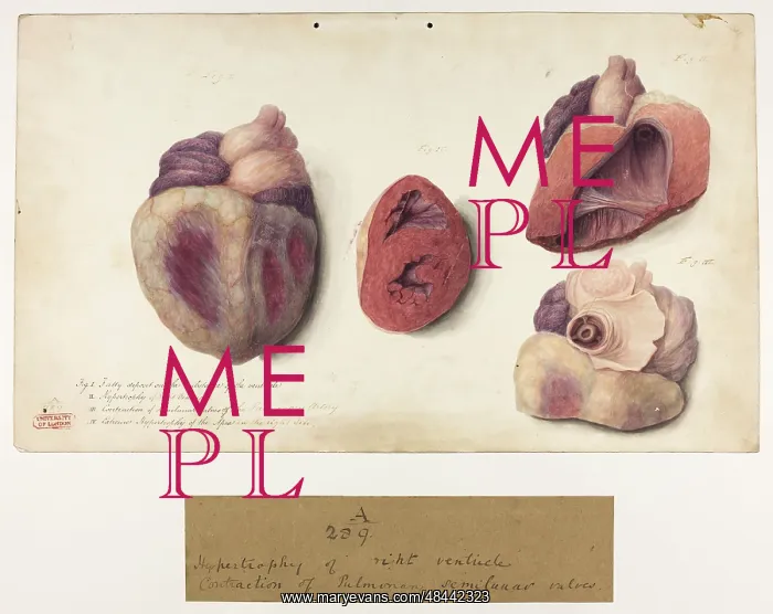  : Hypertrophy of Right Ventricle