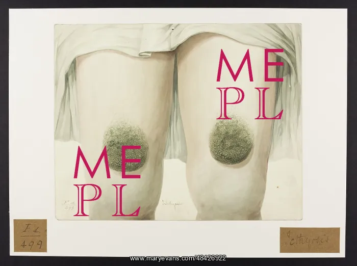 : Icthyosis. Hopital de la Pitie, Paris, Oct 1830 : Icthyosis. Hopital de la Pitie, Paris, Oct 1830