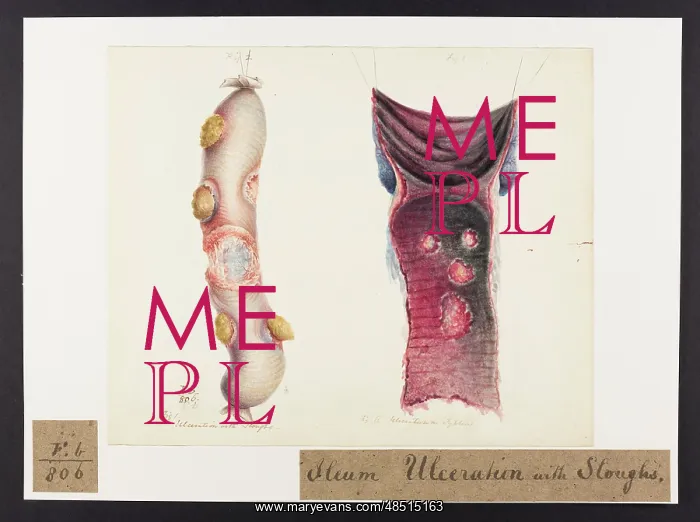 : Ileum: Ulceration and Sloughs : Ileum: Ulceration and Sloughs