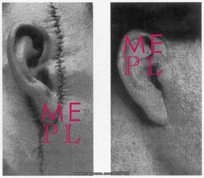 : Improvements in Plastic Surgery, Before and After, c. 1920s : Improvements in Plastic Surgery, Before and After, c. 1920s