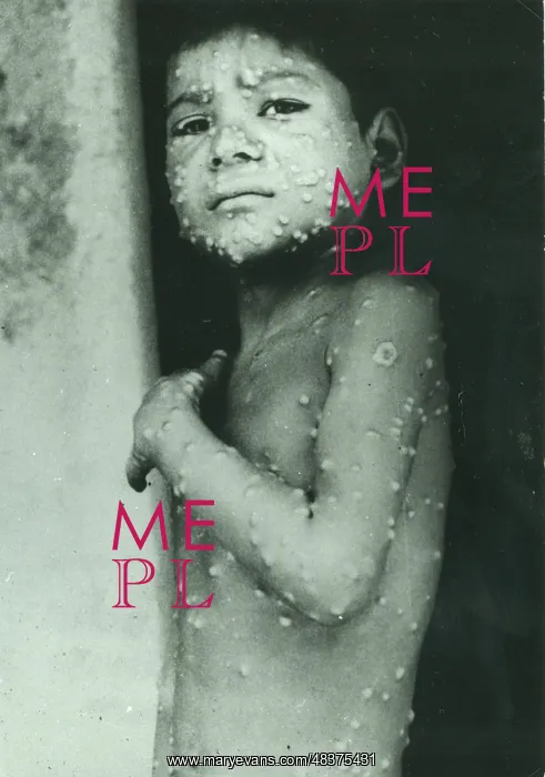 : Last indigenous case of Smallpox in India, Katihar : Last indigenous case of Smallpox in India, Katihar