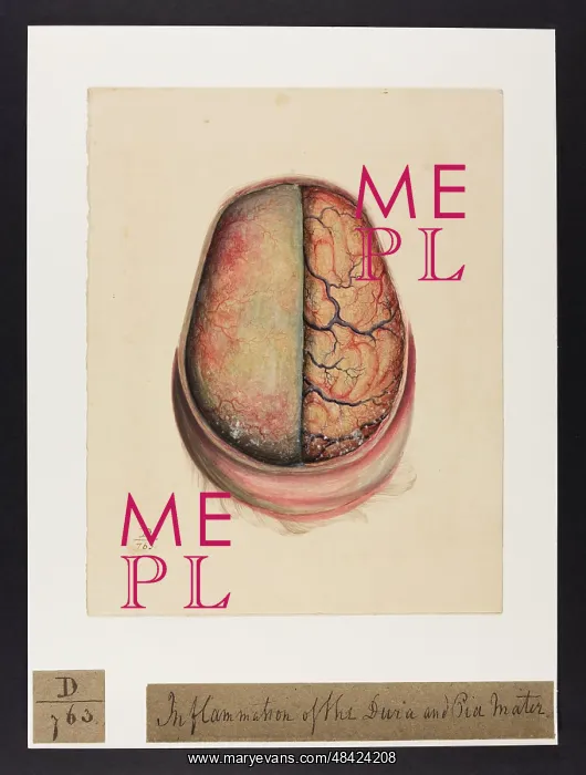: Inflammation of the dura and pia mater : Inflammation of the dura and pia mater