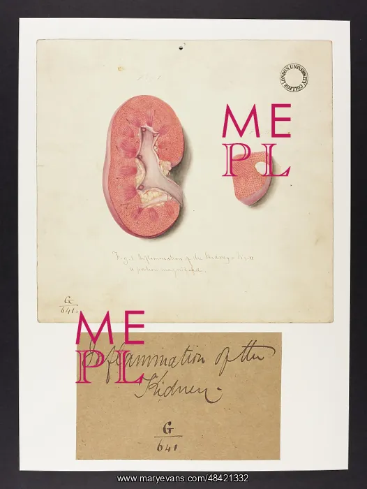 : Inflammation of the Kidney : Inflammation of the Kidney