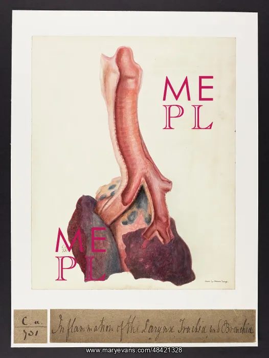 : Inflammation of Larynx, Trachea and Bronchia : Inflammation of Larynx, Trachea and Bronchia