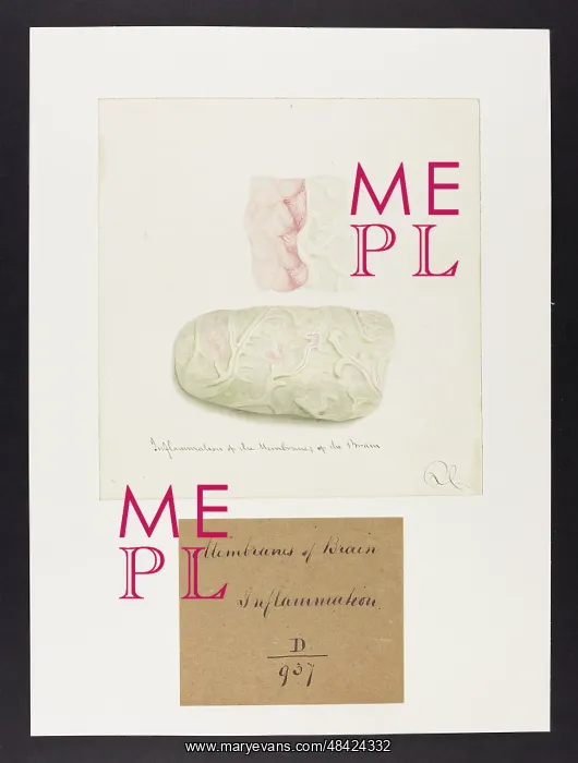 : Inflammation of the Membranes of the Brain : Inflammation of the Membranes of the Brain