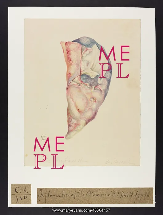 : Inflammation of the Pleura : Inflammation of the Pleura