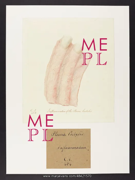 : Inflammation of the Pleura Costalis : Inflammation of the Pleura Costalis