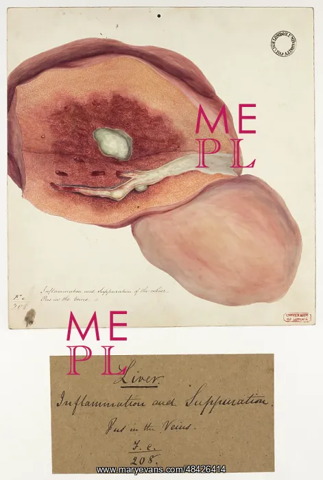 : Inflammation and Suppuration of the Liver : Inflammation and Suppuration of the Liver