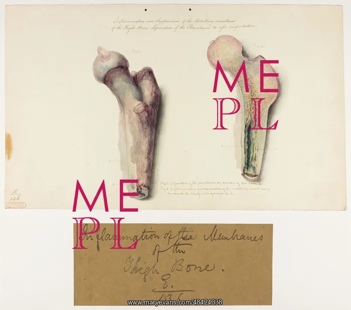  : Inflammation and Suppuration of the Medullary Membrane