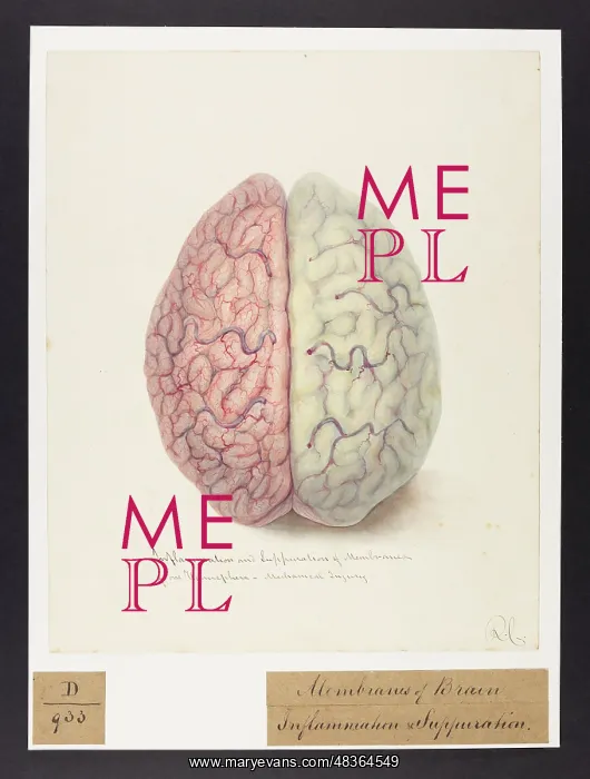 : Inflammation & Suppuration of Membranes of One Hemisphere : Inflammation & Suppuration of Membranes of One Hemisphere