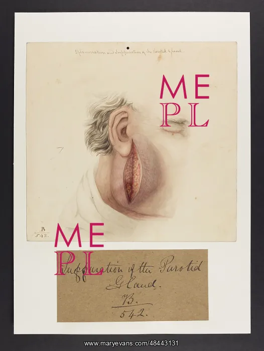 : Inflammation and Suppuration of the Parotid Gland : Inflammation and Suppuration of the Parotid Gland
