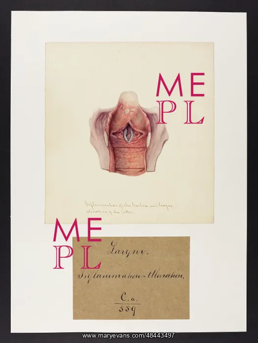 : Inflammation of the Trachea and Larynx : Inflammation of the Trachea and Larynx