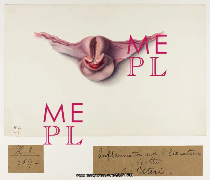 : Inflammation and Ulceration of OS Uteri : Inflammation and Ulceration of OS Uteri