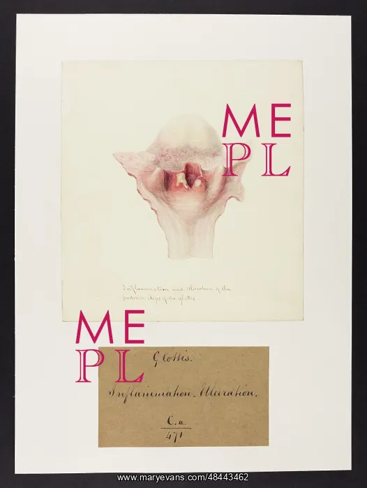 : Inflammation, Ulceration of Posterior Edges of the Glottis : Inflammation, Ulceration of Posterior Edges of the Glottis