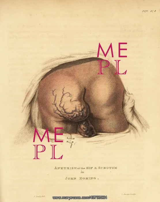 : Inoperable aneurysmal tumor on the buttocks, 1815 : Inoperable aneurysmal tumor on the buttocks, 1815