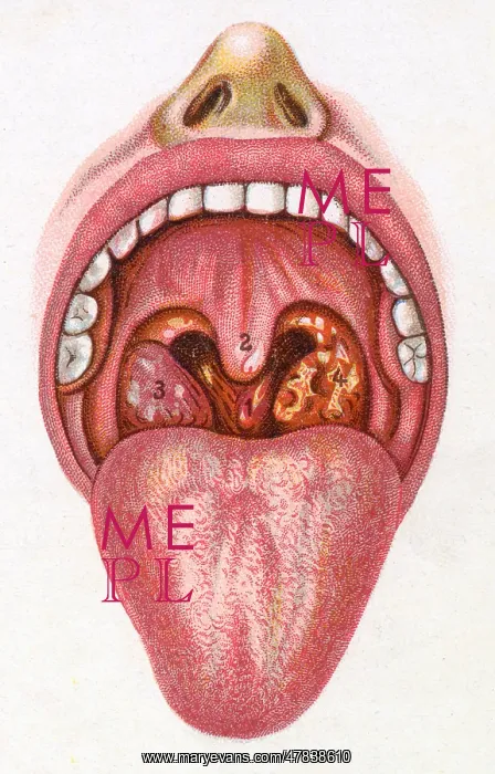 : Inside of a mouth of person with diphtheria : Inside of a mouth of person with diphtheria