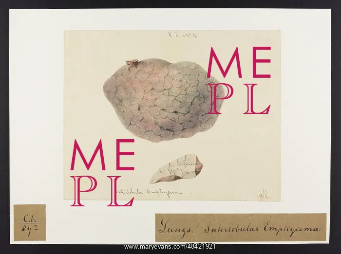 : Interlobular Emphysema : Interlobular Emphysema