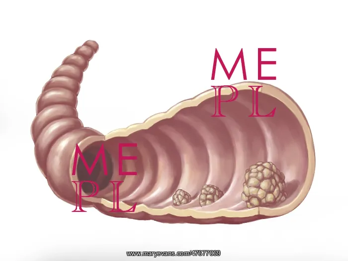 : Intestinal Polyps, Illustration : Intestinal Polyps, Illustration
