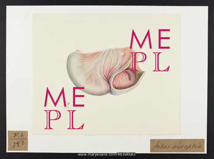 : An Intussusception with Jejunum / Ileum : An Intussusception with Jejunum / Ileum