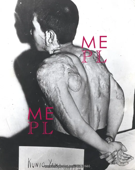 : Japanese Nuclear Bomb Victim : Japanese Nuclear Bomb Victim