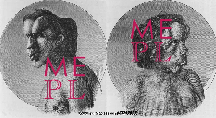 : Joseph Merrick (1862-1890), known as the ? : Joseph Merrick (1862-1890), known as the ?