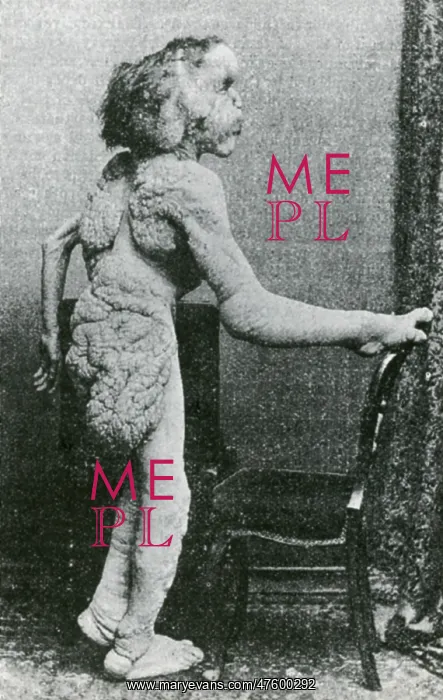 : Joseph Merrick, The Elephant Man : Joseph Merrick, The Elephant Man