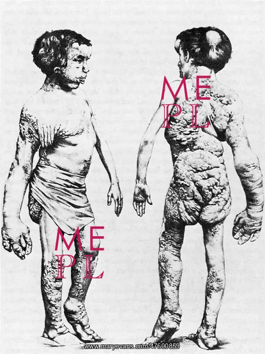 : Joseph Merrick, The Elephant Man : Joseph Merrick, The Elephant Man